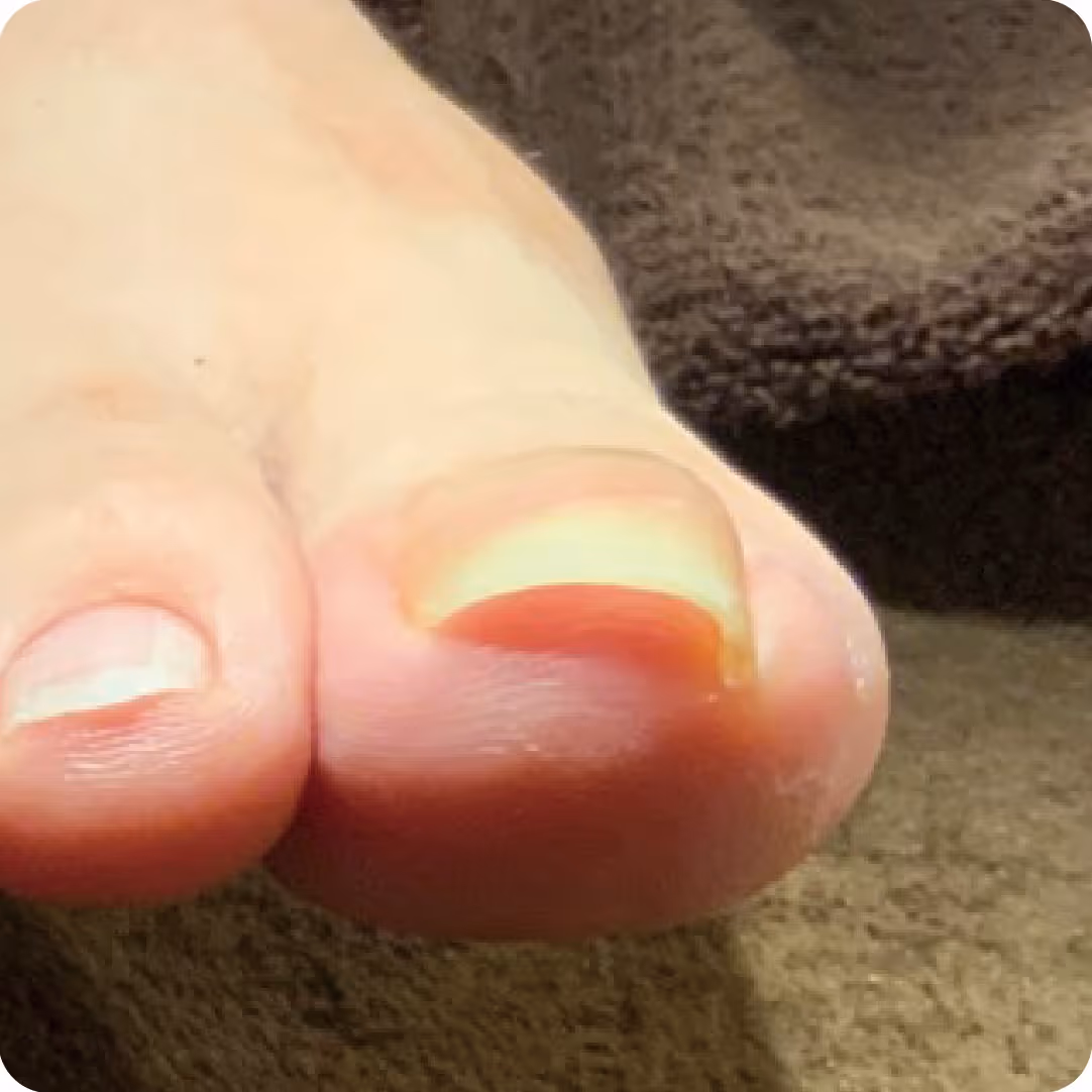 巻き爪施術の実績イメージ