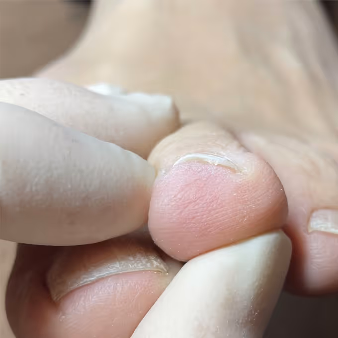 巻き爪の症例イメージ