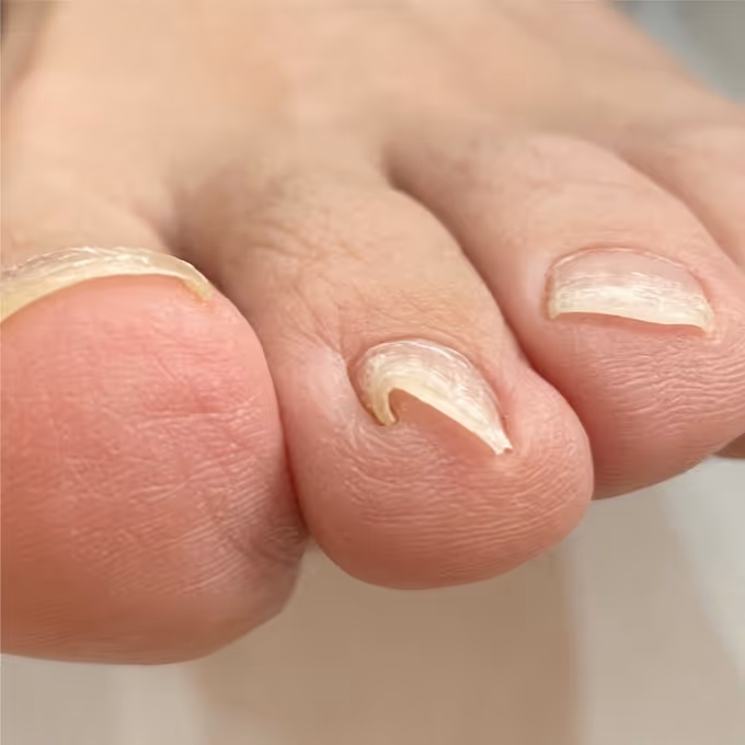 巻き爪の症例イメージ