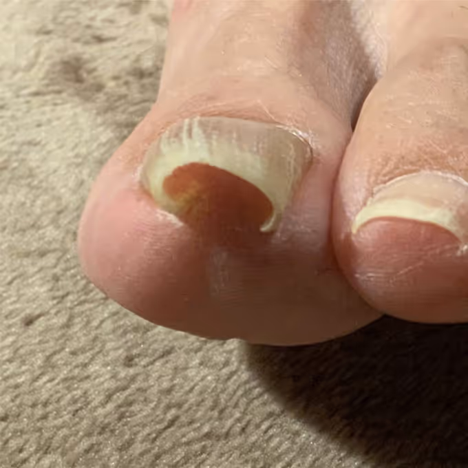 巻き爪の症例イメージ