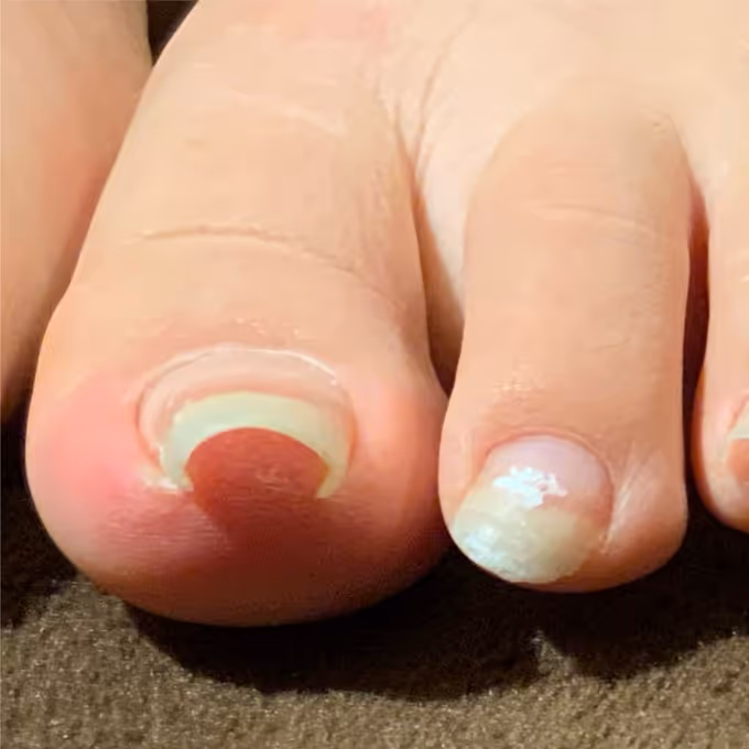 巻き爪の症例イメージ