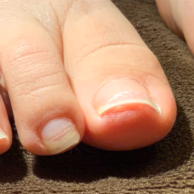 巻き爪施術の実績イメージ