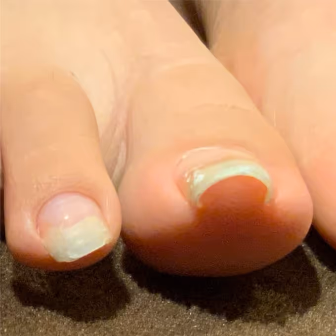 巻き爪施術の実績イメージ