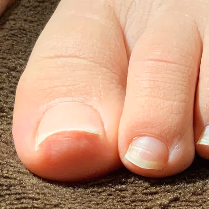 巻き爪の症例イメージ