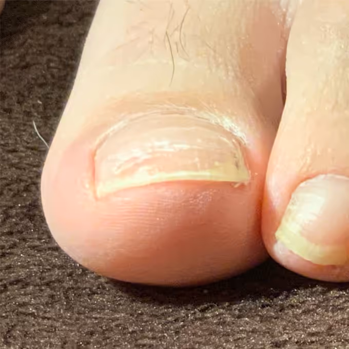 巻き爪施術の実績イメージ