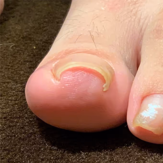 巻き爪施術の実績イメージ