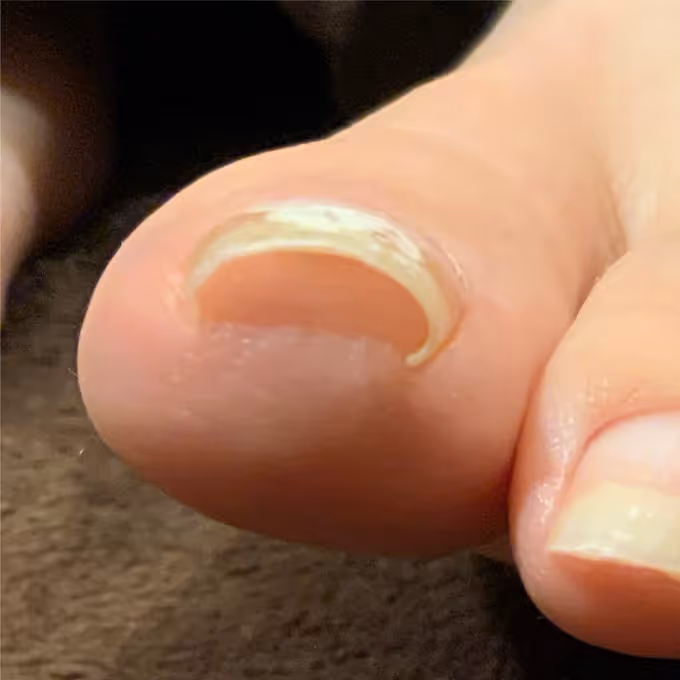 巻き爪の症例イメージ