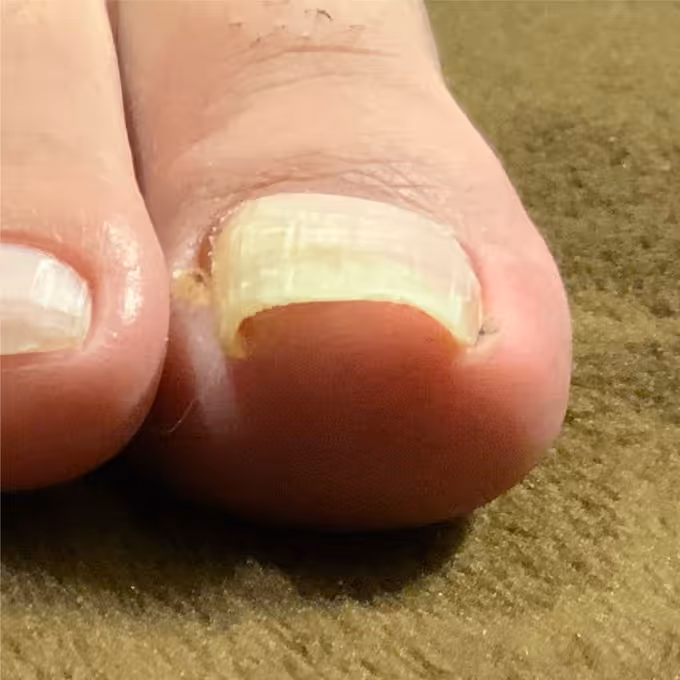 巻き爪施術の実績イメージ