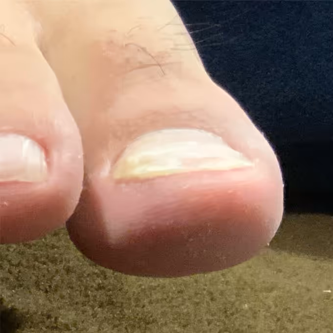 巻き爪施術の実績イメージ