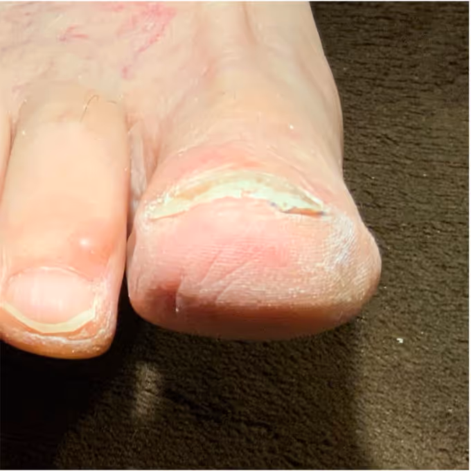 巻き爪施術の実績イメージ