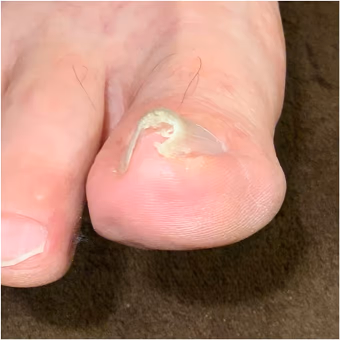 巻き爪施術の実績イメージ