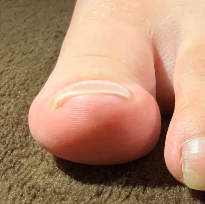 巻き爪の症例イメージ