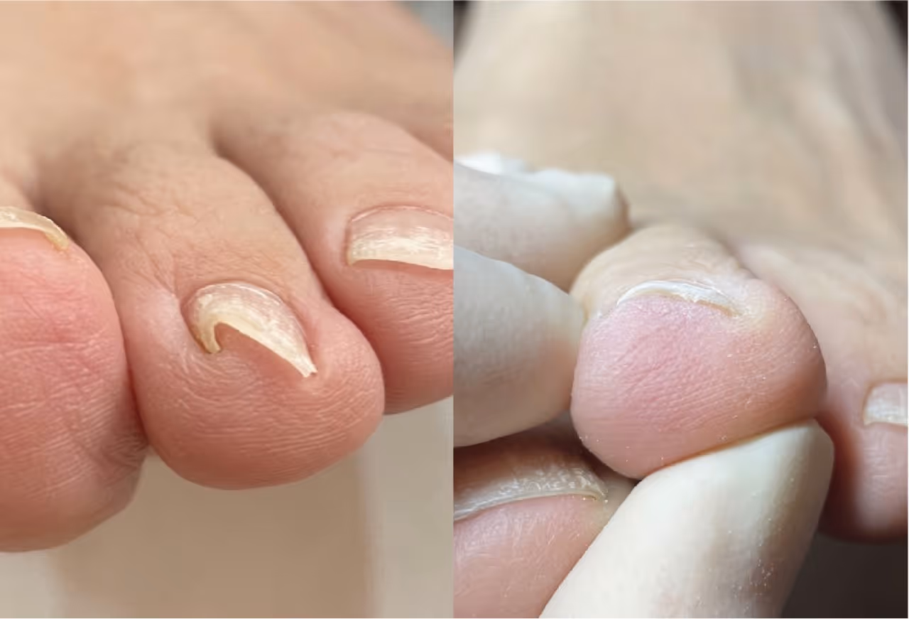 巻き爪施術の実績写真