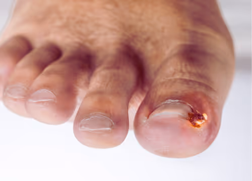 爪に肉芽ができている様子