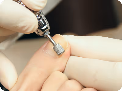 巻き爪治療施術のイメージ