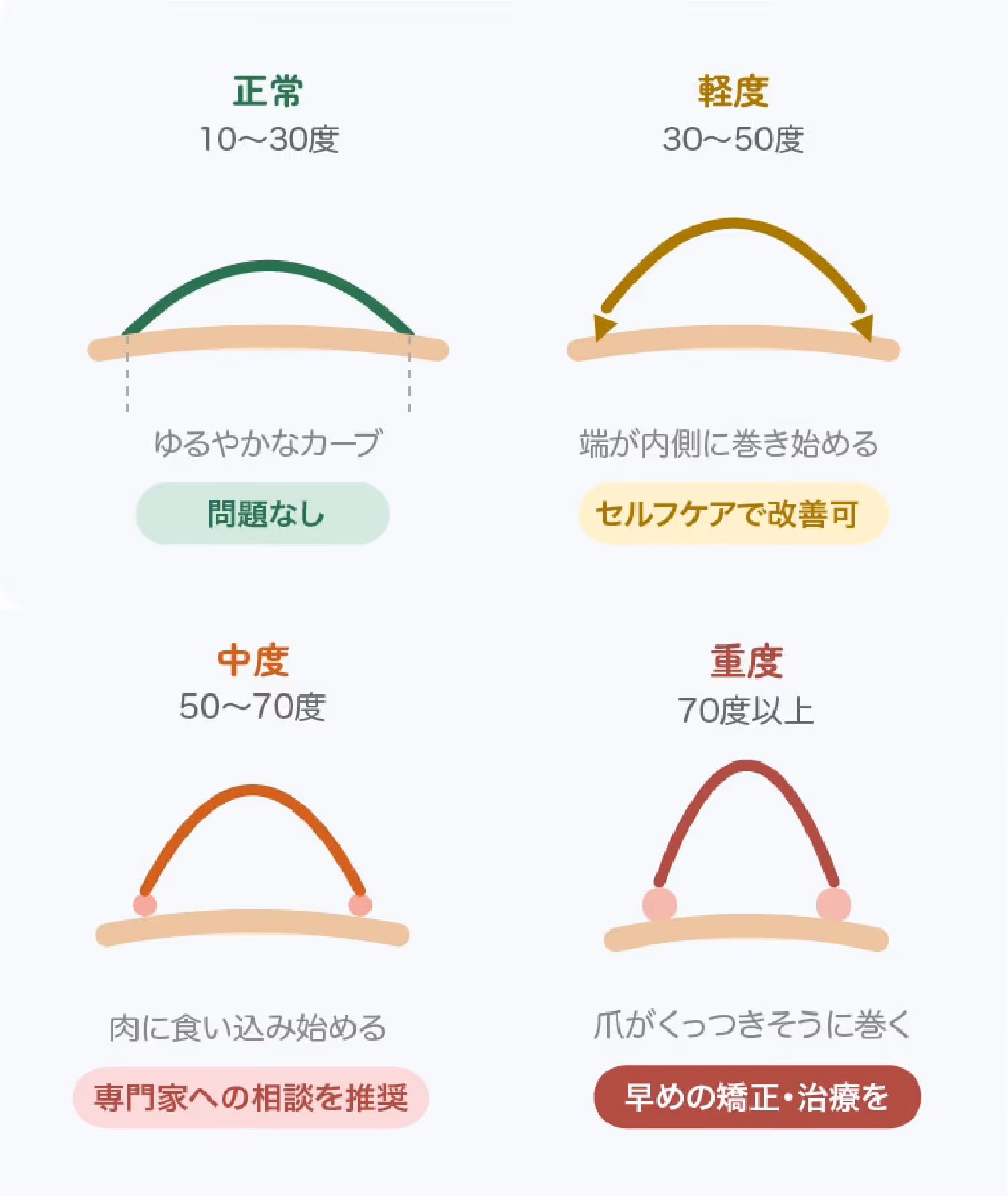 巻き爪の重症度を示す爪の断面図。正常（10〜30度）・軽度（30〜50度）・中度（50〜70度）・重度（70度以上）の4段階で、爪のカーブがどのように変化するかを図解