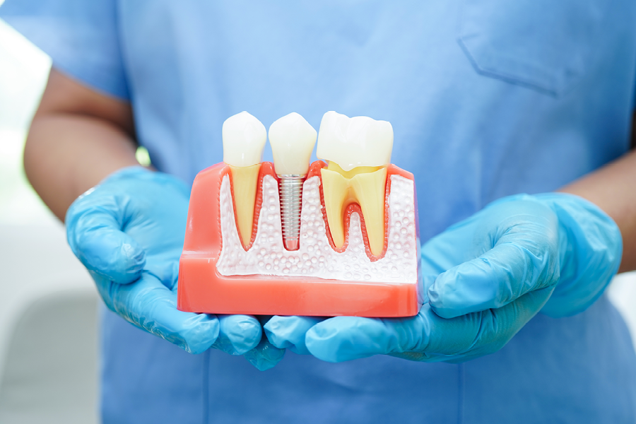 Your Guide to Healing After a Dental Implant