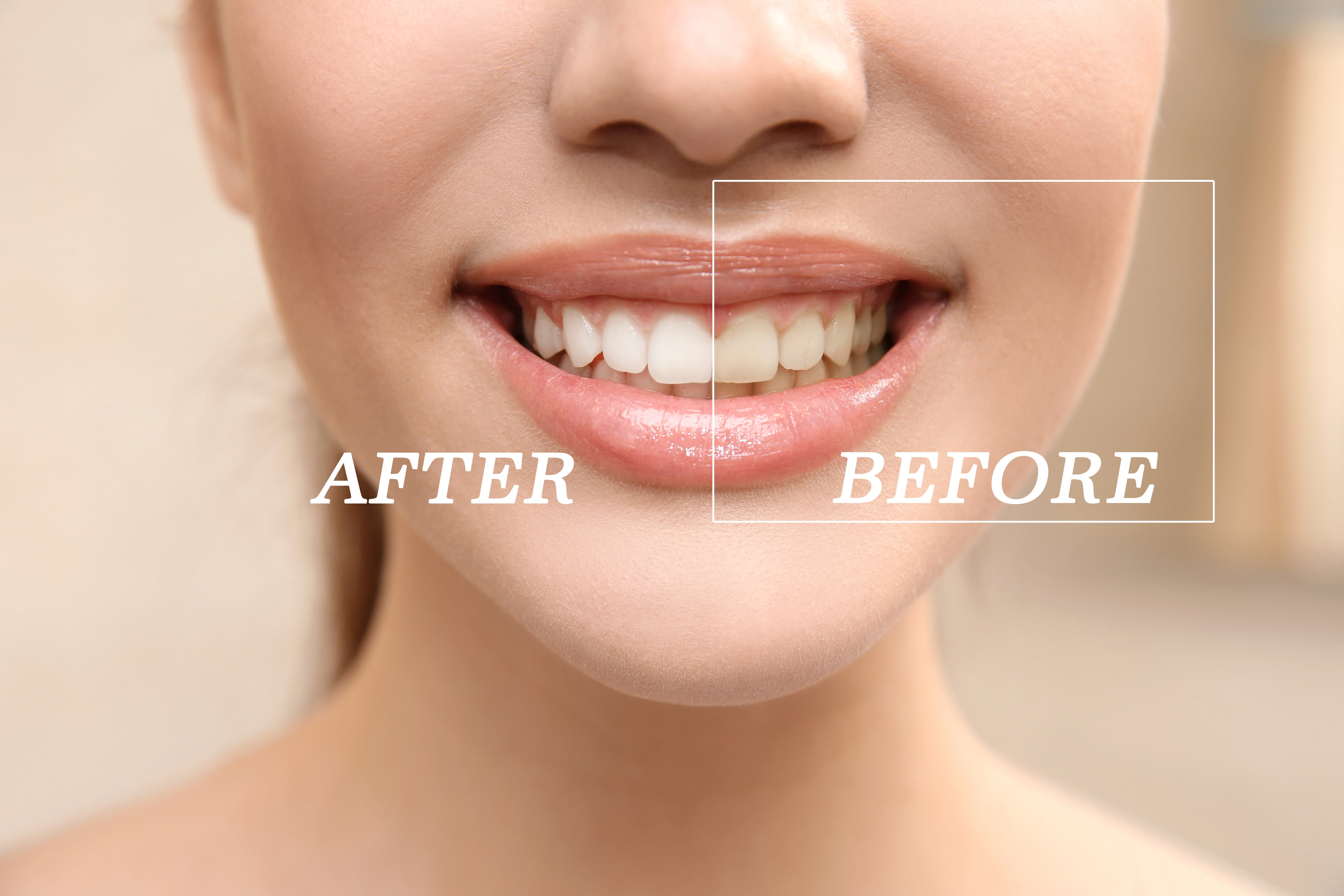 Patient receiving professional teeth whitening treatment at Main Street Dental, Vista, CA