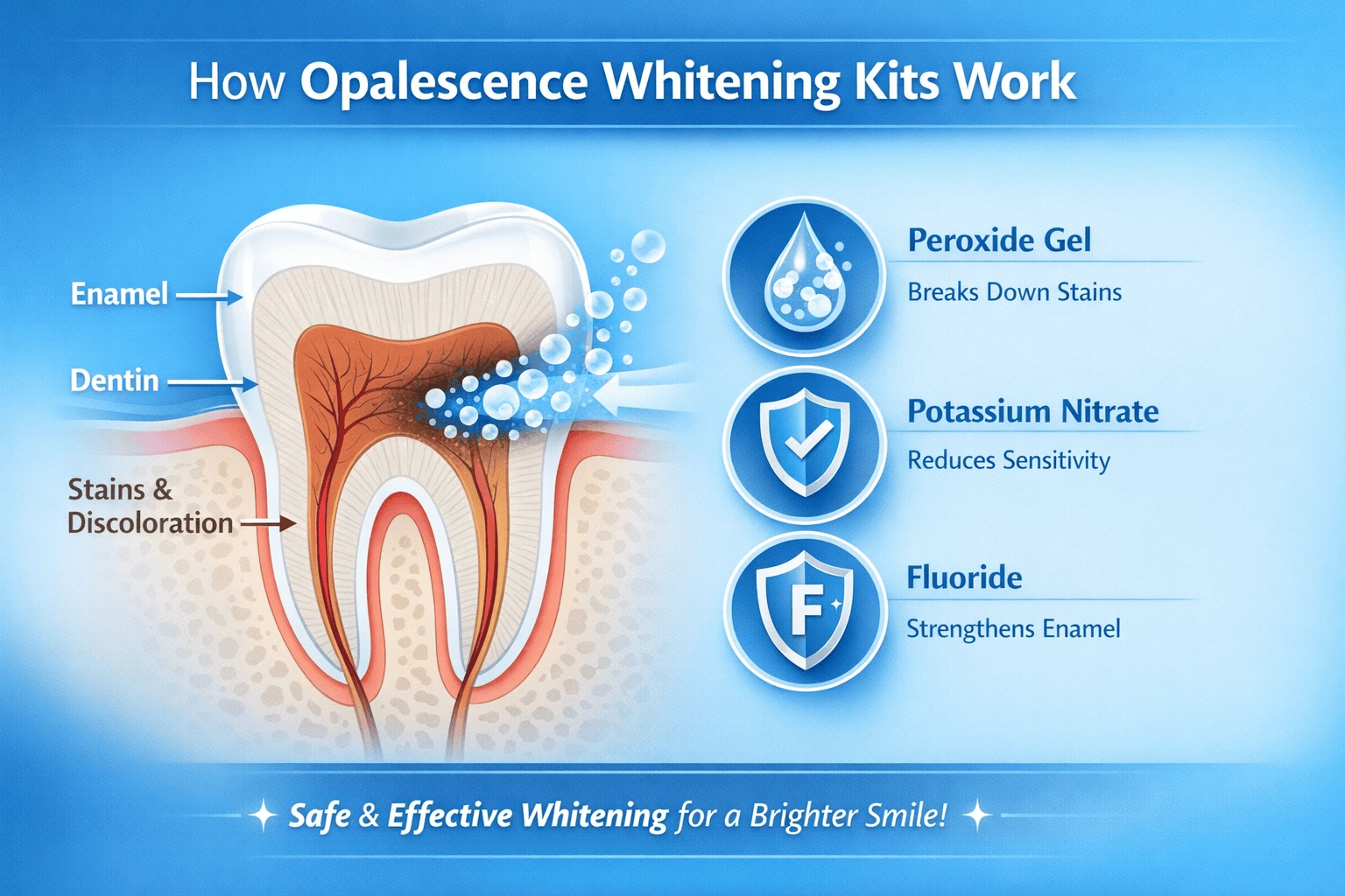 Diagram showing how Opalescence teeth whitening kits work, highlighting gel tray on teeth and whitening process on enamel and dentin, for Vista, CA patients.