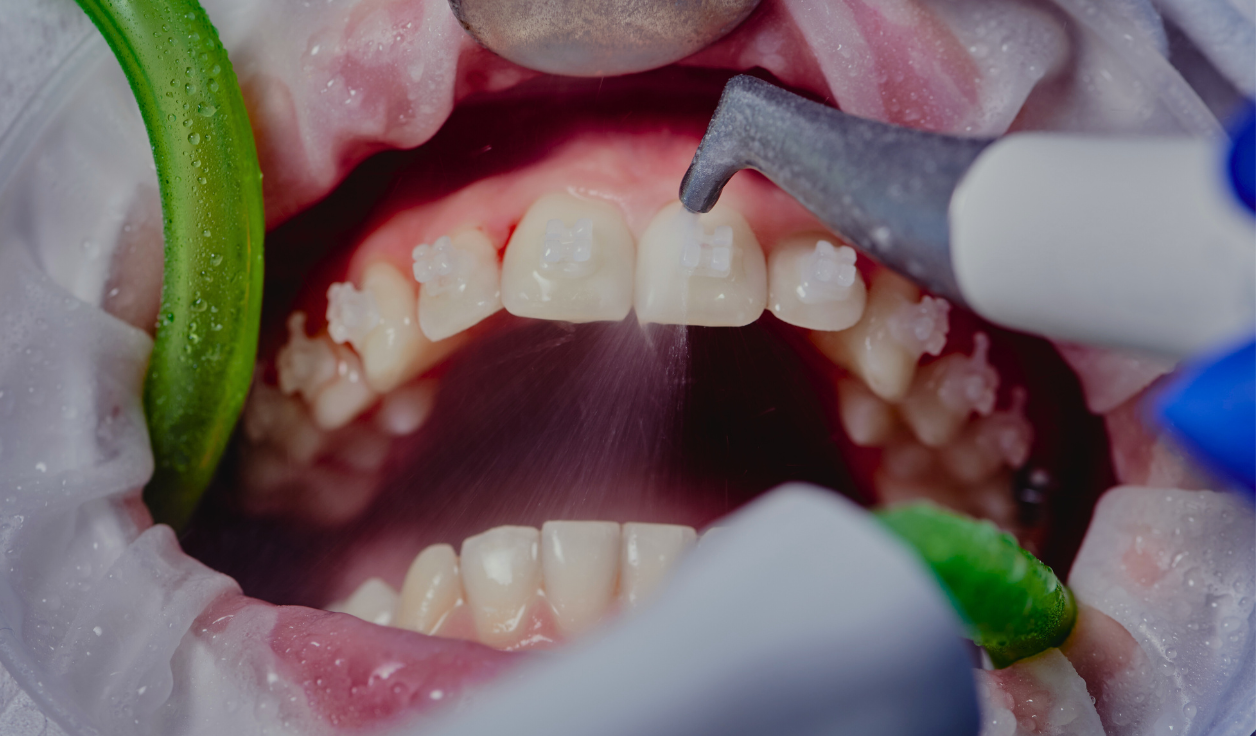 Dentist performing a deep teeth cleaning on a patient in Vista, CA, showing plaque and tartar removal.