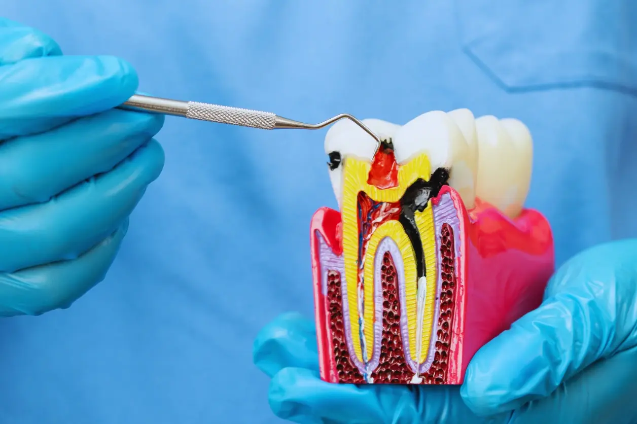 Dental implant replacing a missing tooth, fixed in the jawbone for natural look, strong bite, and long-term bone support