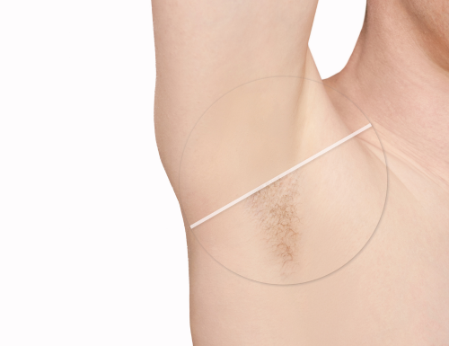 hair laser removal , before-after
