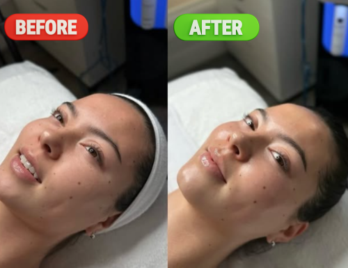 hydrafacial-treatment-before-after-gallery