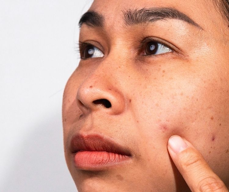 how-to-treat-dull-skin