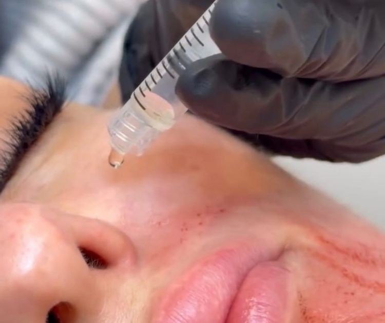 microneedling-exosomes- yorkville-toronto