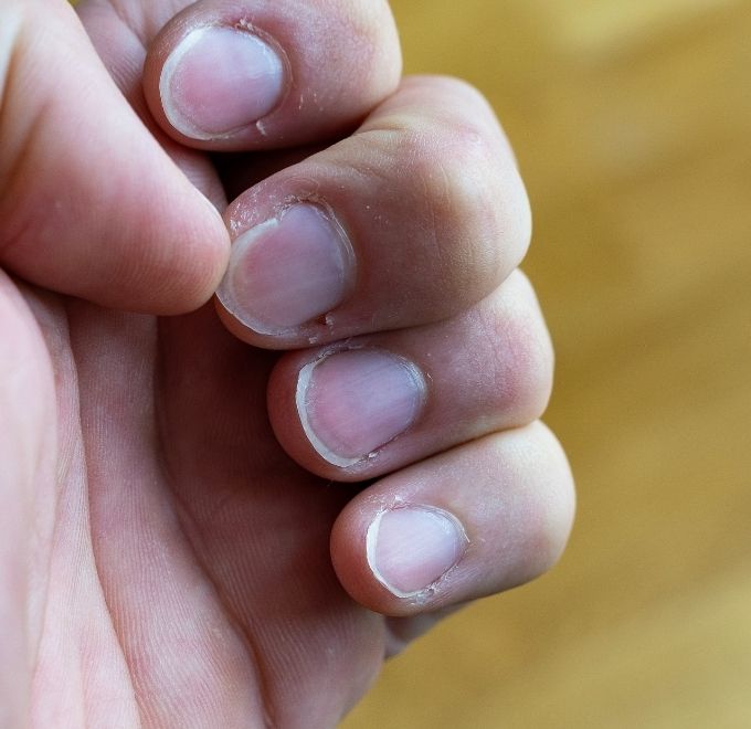 weak bitten nails
