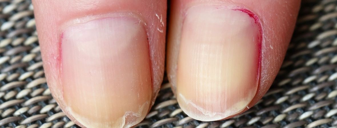 why nails peel