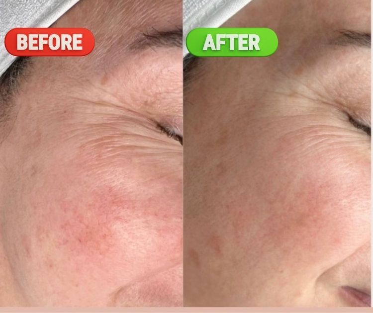 microneedling-exosomes-before-after