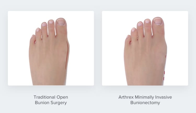 A comparison of the scars from traditional bunion surgery and the smaller Minimally Invasive Bunionectomy scars.