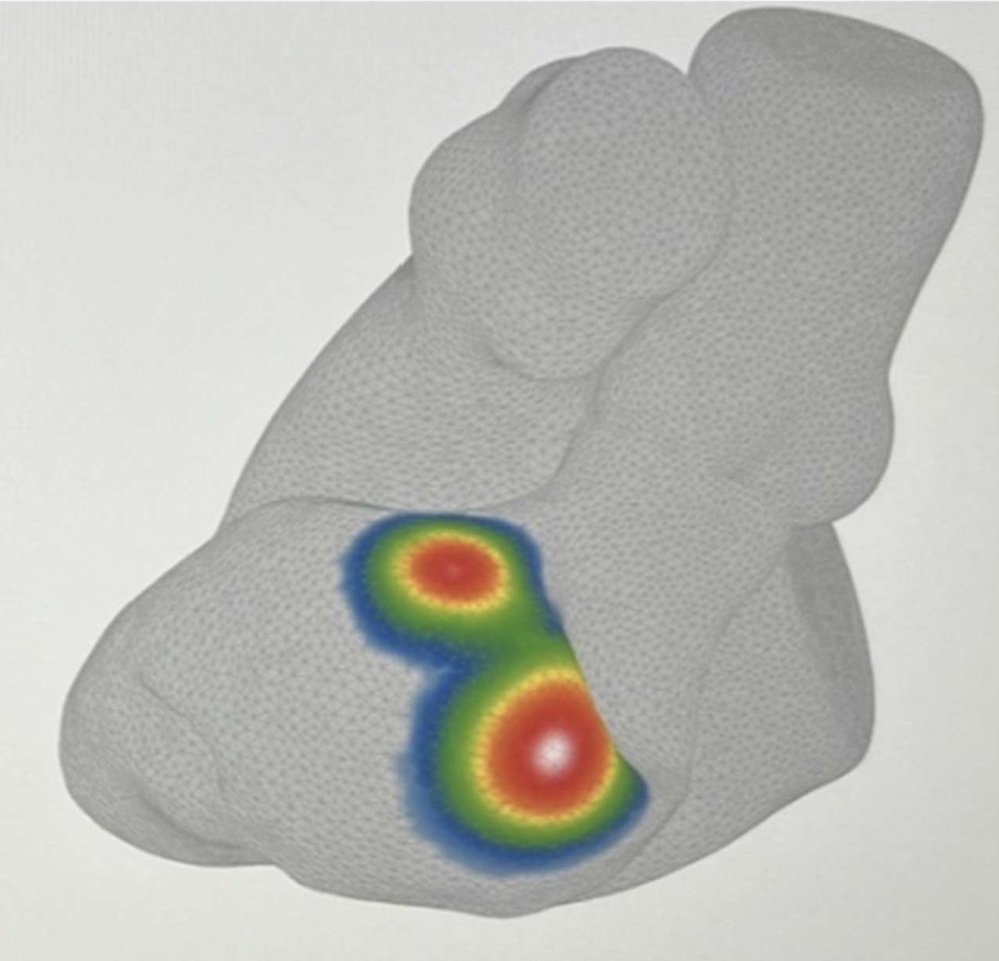 Study Demonstrates vMap Localization for Hemodynamically Unstable VT