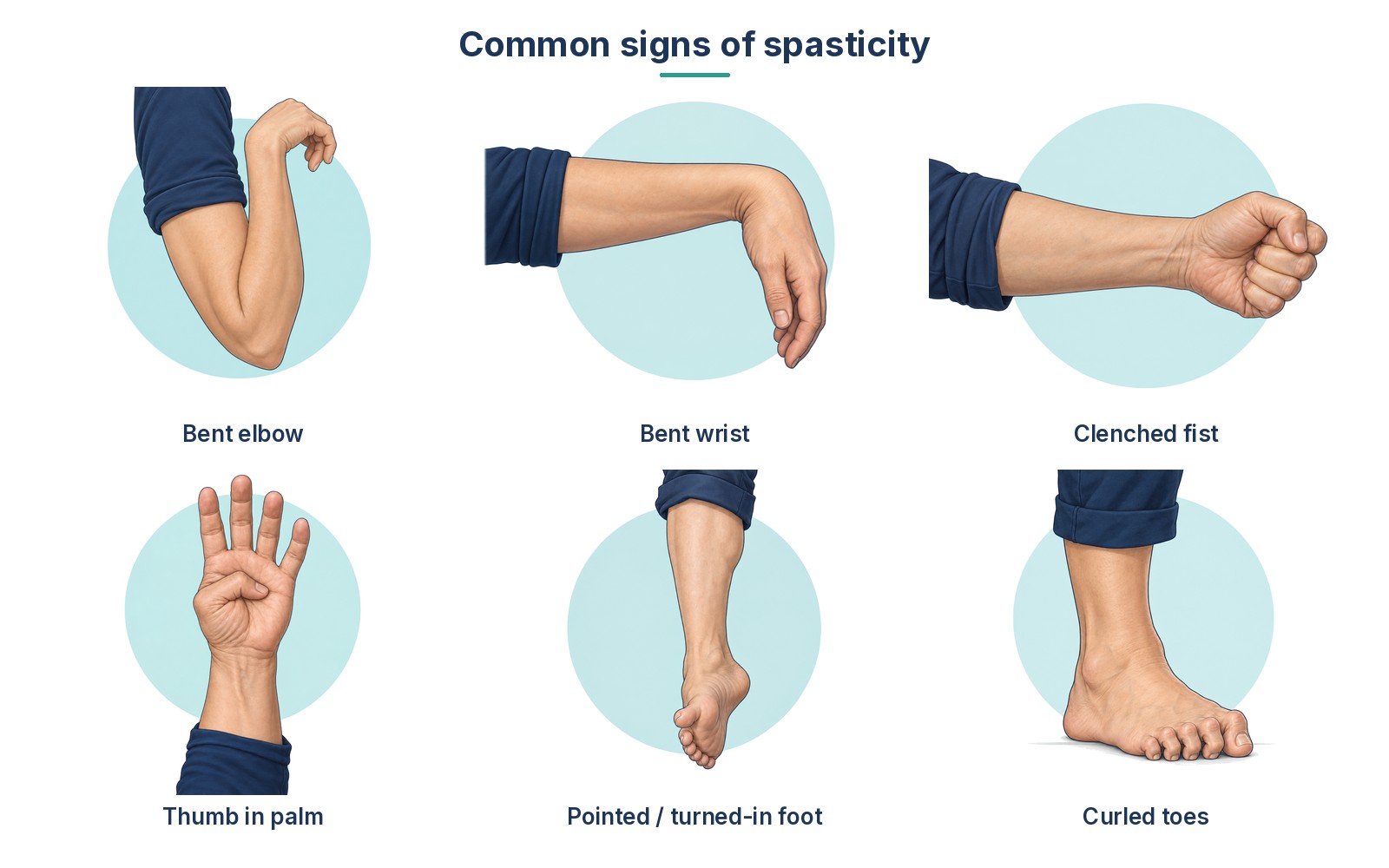 Illustration of common signs of spasticity: bent elbow, bent wrist, clenched fist, thumb in palm, pointed and turned-in foot, curled toes