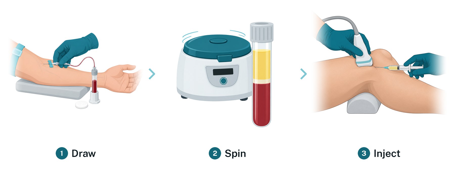 Illustration of PRP preparation in three steps: a small blood draw, the blood spun in a centrifuge to separate the platelet-rich plasma, and an ultrasound-guided injection into the side of the knee.