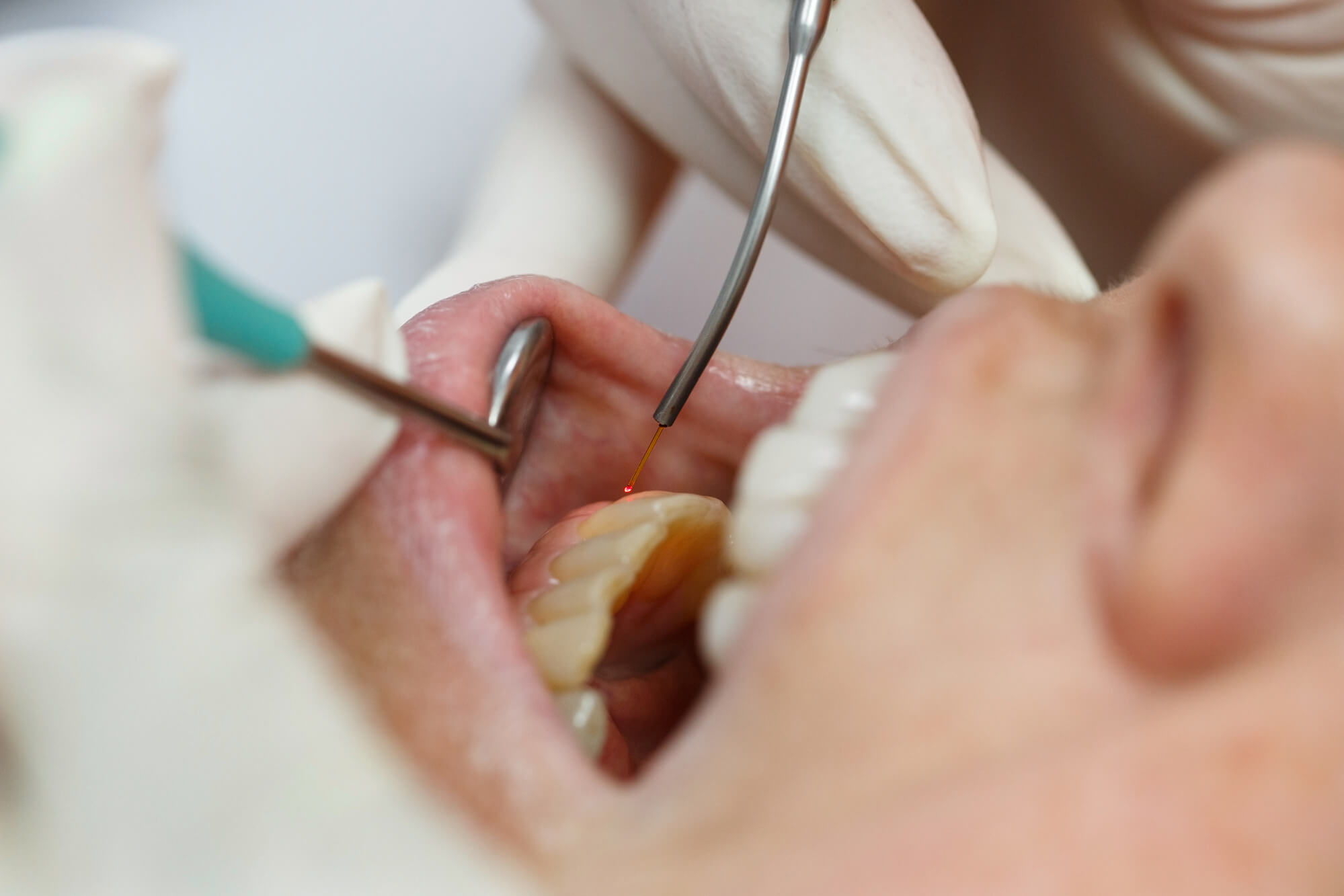 a patient receiving Gum disease treatment in Issaquah