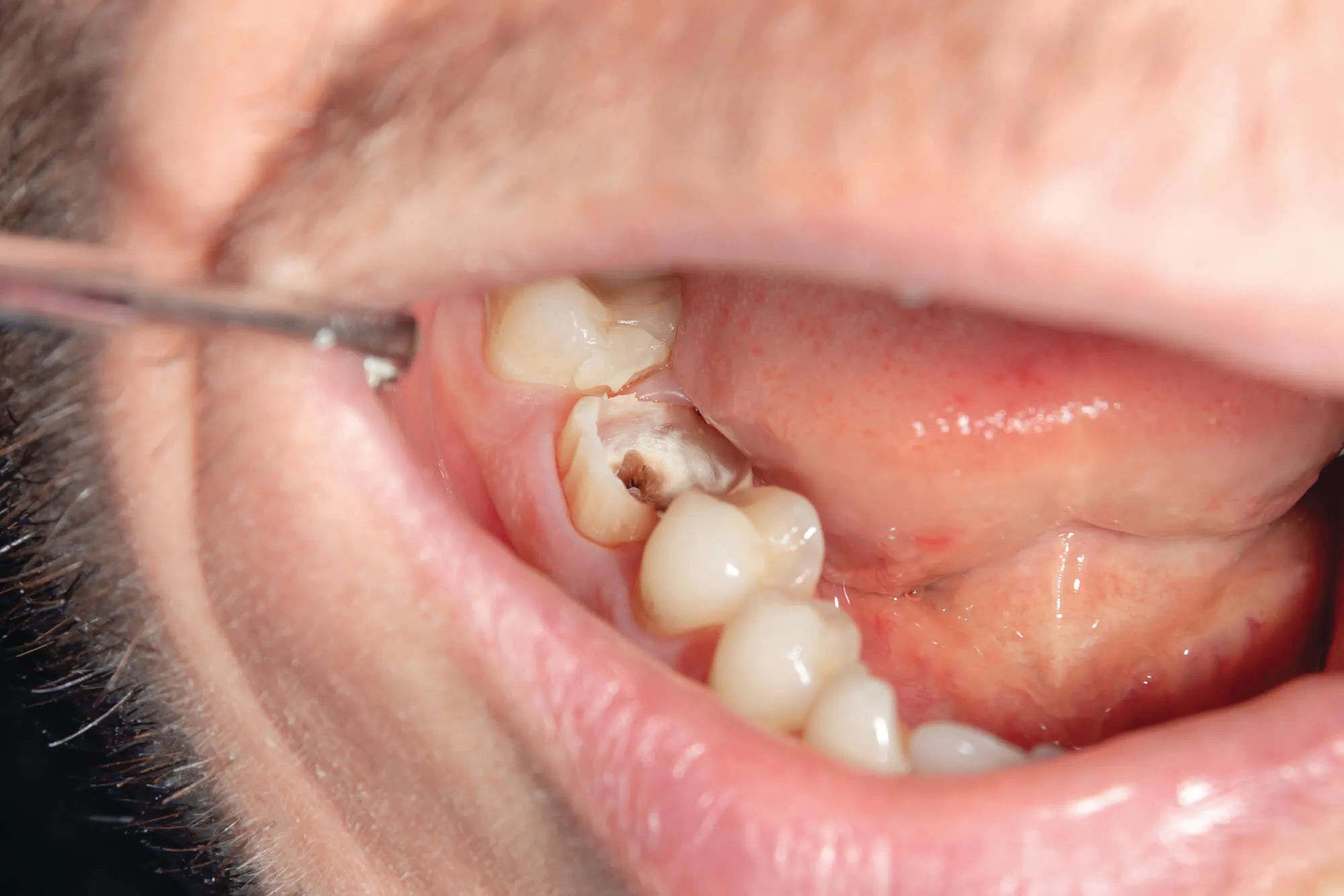 deep cavity needs Root canal Issaquah