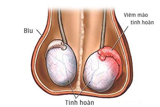đau tinh hoàn nhưng không sưng