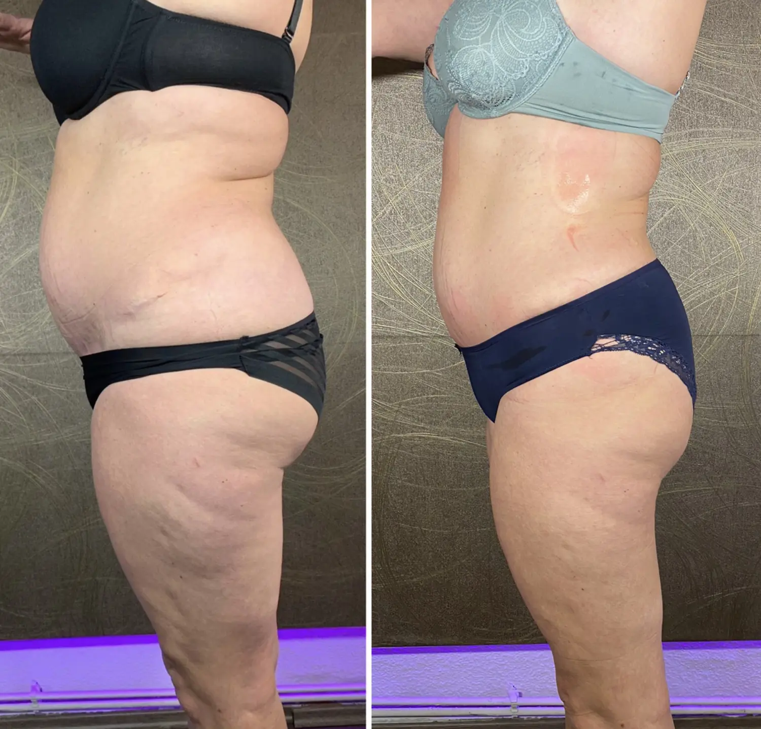 Genesis Radiofrequenz