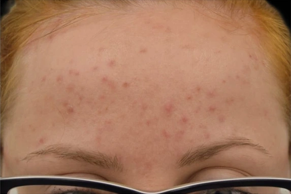 before and after treatment