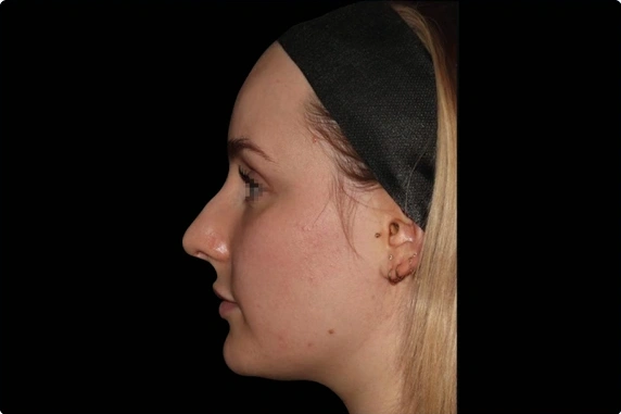 before and after treatment