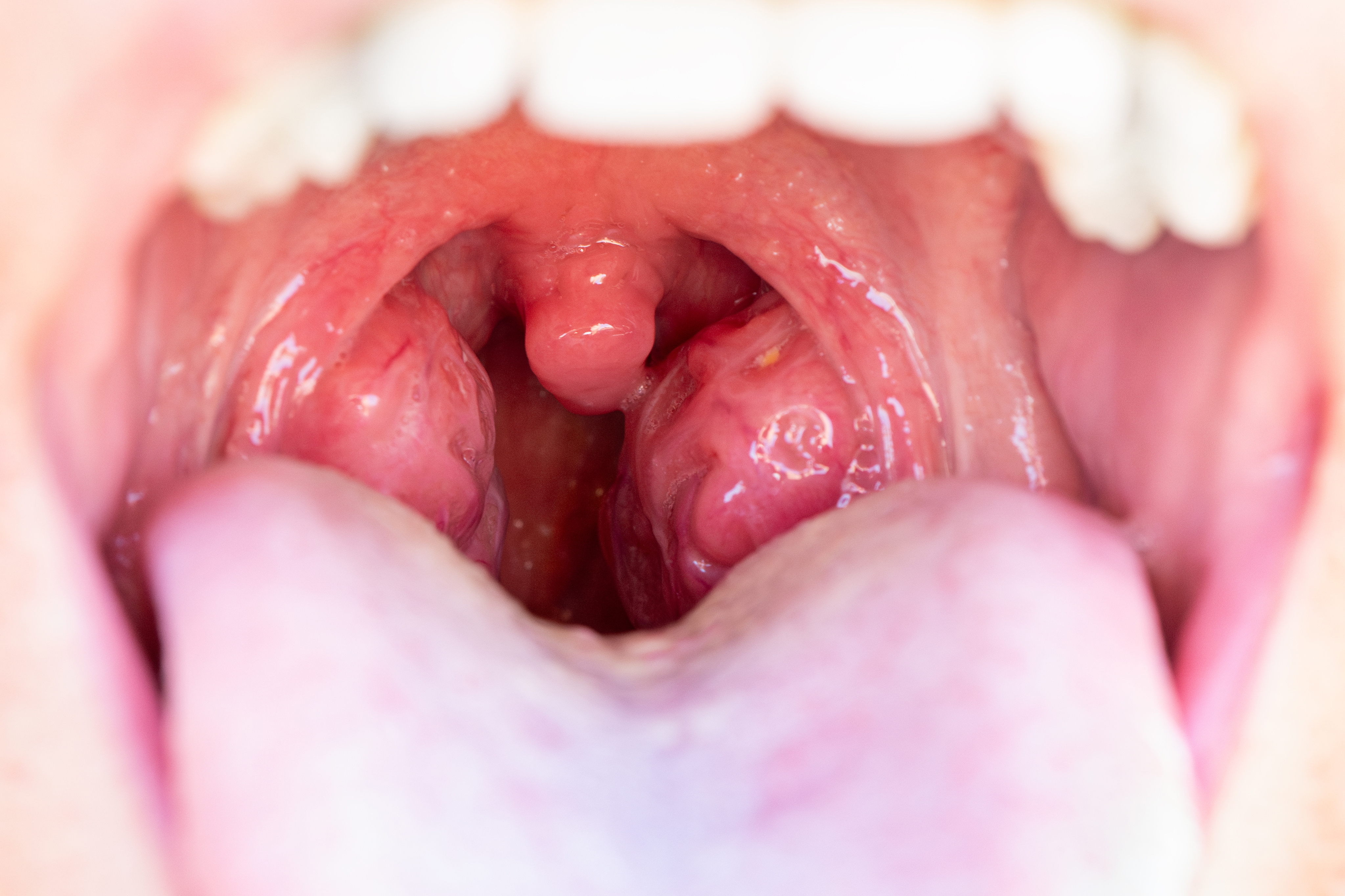 Canker Sores on the Tonsils: How Lifestyle Habits Play a Role