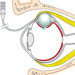 The Odyssey of Cryotherapy in Retinal Surgery