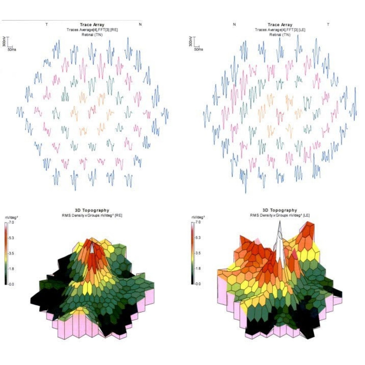 Tracing the Origin of the Clinical Electroretinogram