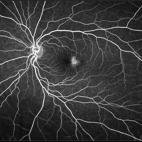 Evolving Treatment for Macular Telangiectasia (MacTel)