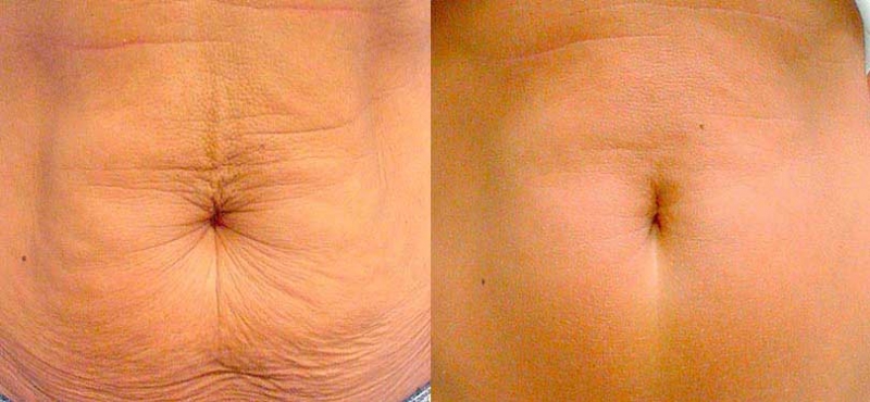 women emsculpt before and after