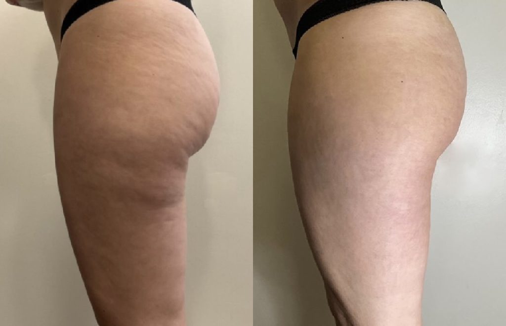 men emsculpt procedure