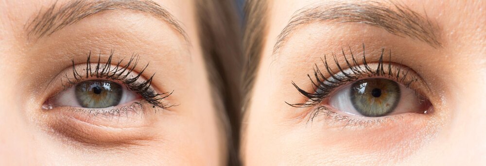 Before and after Salmon DNA skin booster treatment at Novelty Clinic Dubai