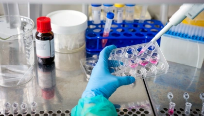 Cellules cancéreuses ovariennes observées au microscope en laboratoire